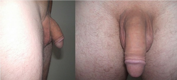Shemale penis enlargement